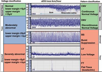 Optimal neuromonitoring techniques in neonates with hypoxic ischemic encephalopathy